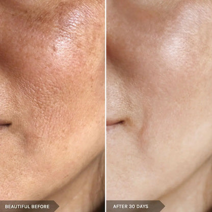 Cosmac Best Acne Treatment Kit with Free Anti Acne Serum - Cosmac