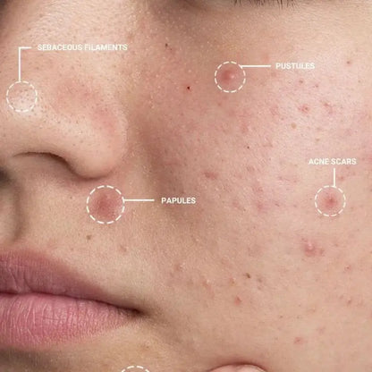 Acnemac Anti Acne Face Wash - Cosmac